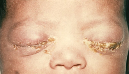 gonococcal ophthalmia neonatorum Dec 2024 STI Case Studies 