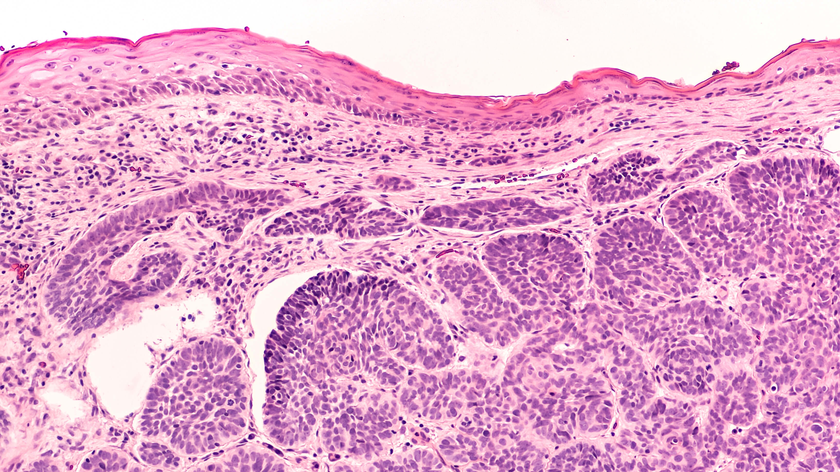 This image depicts histology basal cell carcinoma (BCC). Professional medical imaging for clinical reference and educational purposes. [umbracoNodeId=12332]