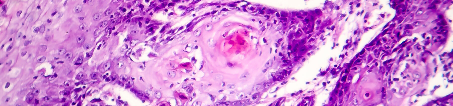 Histology of Squamous cell carcinoma (SCC)