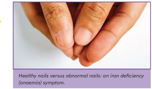 Iron Deficiency June 2021