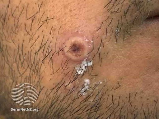 Figure 2. Umbilicated mpox vesicle on male’s cheek at day 4 of infection.