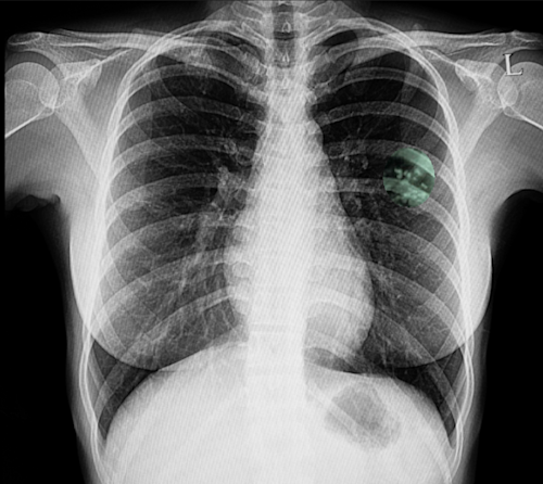 tuberculosis - QuantiFERON-TB Gold - December 2020